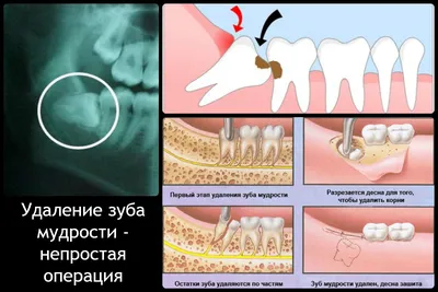 Воспалилась десна после удаления зуба: почему так происходит и что нужно  делать?