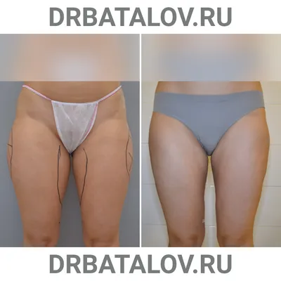 Липосакция спины в Москве для женщин и мужчин, фото до и после, цены на  операцию