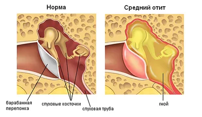 Отит - определение заболевания, виды, симптомы, диагностика и лечение