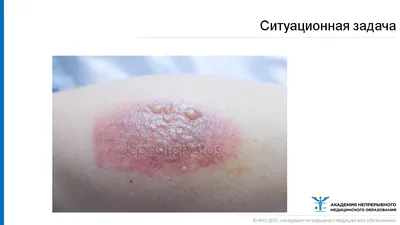 Навальному после нападения диагностировали химический ожог глаза — РБК