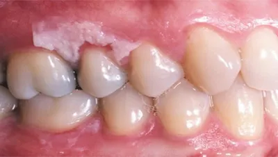 Ожоги слизистой оболочки полости рта: диагностика и лечение
