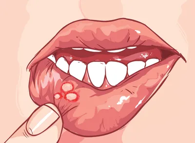Лечение глоссалгии: боль и жжение языка — статьи «Зубная Формула»