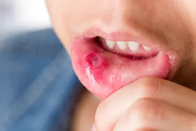Кандидоз полости рта | Симптомы и лечение | причины появления