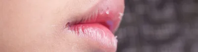 Почему опухает язык с горлом или губами, что делать в этом случае