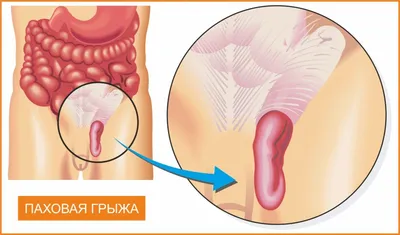 Грыжи: причины, лечение и профилактика