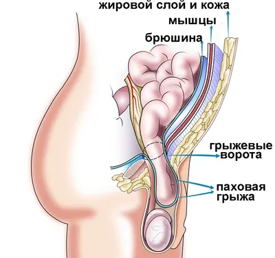 Паховая и бедренная грыжа - Новая мировая хирургия