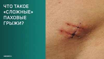 kherson_surgery - Паховая грыжа – это болезненное состояние, которое  сопровождается выпадением внутренних органов, в основном, кишечника,  большого сальника и яичников (у женщин) через брюшную стенку в паховый  канал. У женщин в нем