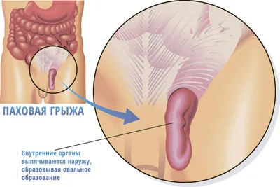 Что такое «сложные» паховые грыжи?