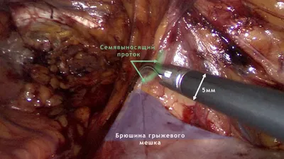 Как определить наличие паховой грыжи у женщин - блог Виртус