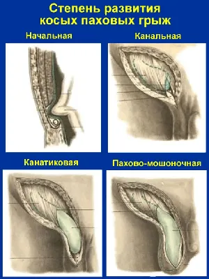 Паховая грыжа у мужчин