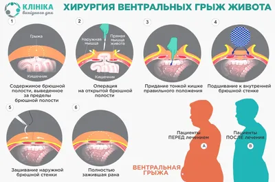 ✓ Лечение левосторонней паховой грыжи ⋆ 2024