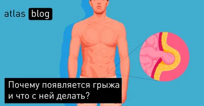 Как избавиться от паховой грыжи? - блог Виртус