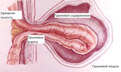 K40.0 Паховая грыжа | Описание болезни, диагностика, лечение