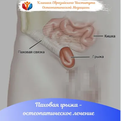 Операция по удалению паховой грыжи - «Паховая грыжа у маленького ребенка |  Как выглядит шрам | Подготовка к операции | Список анализов |  Реабилитационный период» | отзывы