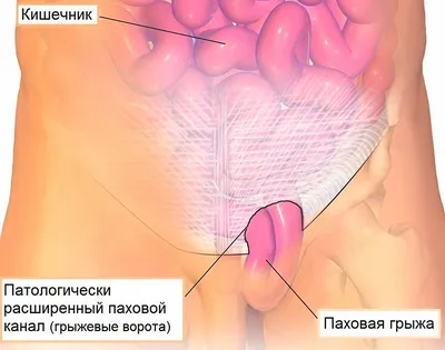 Бедренная грыжа у взрослых: симптомы, причины, лечение, профилактика в  домашних условиях