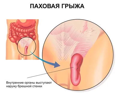 Паховая грыжа - Расстройства пищеварения - Справочник MSD Версия для  потребителей