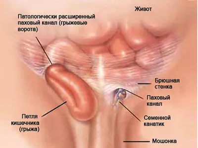 Паховая грыжа у мальчика фото фотографии