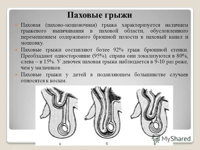 Откуда берётся паховая грыжа и как её убрать - Лайфхакер