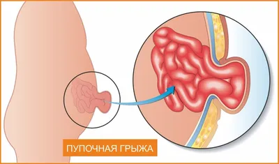 Про грыжу у маленького мальчика | Качурина дочь | Дзен