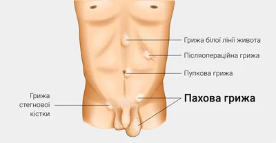 Паховая грыжа: причины, лечение — Благотворительный фонд помощи  недоношенным детям «Право на чудо»