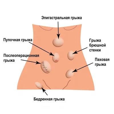 Паховая грыжа (нужен совет) | Пикабу