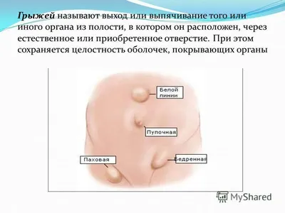 Паховая грыжа - причины развития заболевания, симптомы, диагностика и  лечение