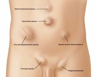 Паховая грыжа у детей - Проблемы со здоровьем у детей - Справочник MSD  Версия для потребителей