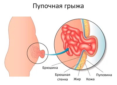 Пупочная грыжа | Op. Dr. Mehtap ERTÜRK