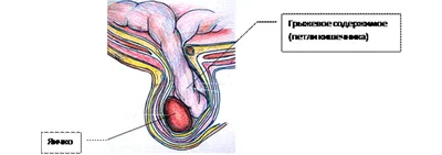 Паховая грыжа у мужчин картинки фотографии