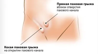 Центр хирургии грыж. Современные методы лечения паховой грыжи. | Москва