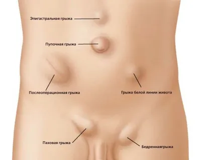 Паховая грыжа - Расстройства пищеварения - Справочник MSD Версия для  потребителей