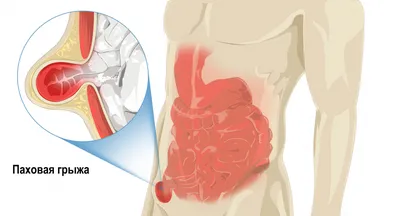Паховая грыжа у женщин — фото, симптомы и лечение без операции