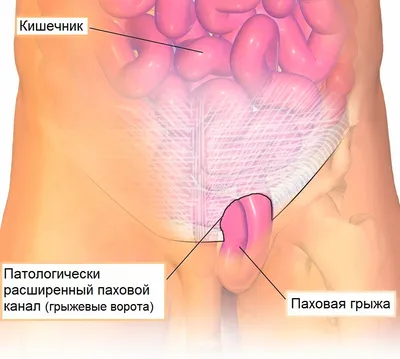 ✓ Лечение косой паховой грыжи ⋆ 2023