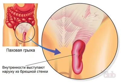 Откуда берётся паховая грыжа и как её убрать - Лайфхакер