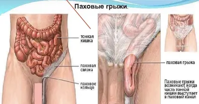 Паховая грыжа у ребёнка: это опасно? - Общество - Новости - Калужский  перекресток Калуга