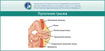 Паховая грыжа у детей