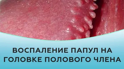 Папилломы: виды, проявления, удаленние и особенности лечения у мужчин и  женщин