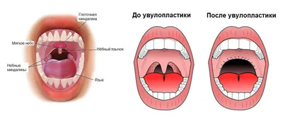 ЛОР. Онк. Переходно-клеточная папиллома. + | Портал радиологов