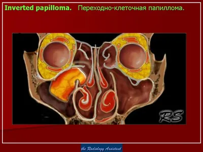 ЛОР. Онк. Переходно-клеточная папиллома. + | Портал радиологов