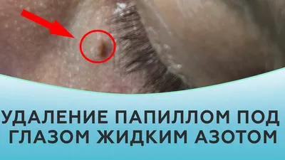 ОТРАЩИВАЕТЕ ПАПИЛОМЫ НА СВОИХ ВЕКАХ? - ЭТО МОЖЕТ БЫТЬ ОПАСНО… - EIZS
