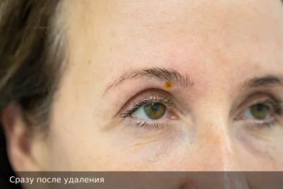 Удаление новообразований на веках лазером в Екатеринбурге, цена.