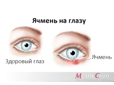 Удаление паппилом, просянок и родинок методом электрокоагуляции - «Удаление  гадкой папилломы возле глаза. Жалею, что не сделала этого раньше!» | отзывы
