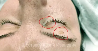 Причины появления и возникновения вируса папилломы человека ВПЧ