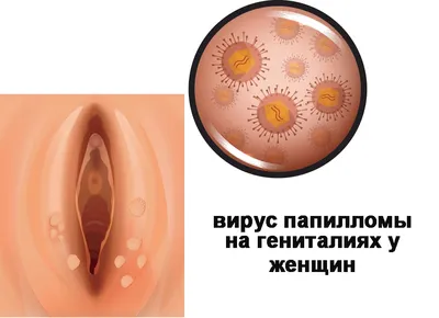 Папилломавирус на гениталиях фото фотографии