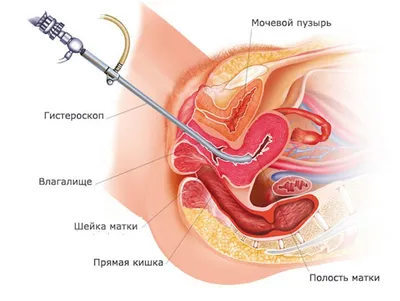 ВПЧ (вирус папилломы человека) | причины, симптомы, типы, диагностика и  лечение папилломавирусной инфекции