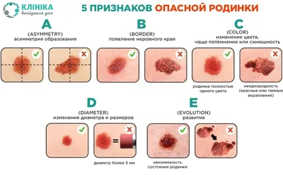 Папиллома: как выглядит у мужчин, женщин; фото, удаление