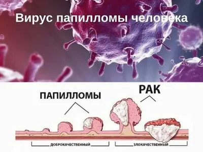 ВПЧ: как передается, как не заразить партнера папилломавирусом