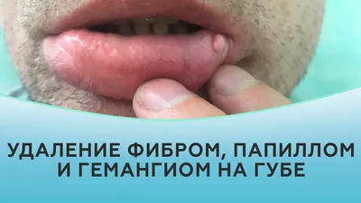 Кандидоз слизистой оболочки полости рта - лечение от клиники \"Азбука  Здоровья\"