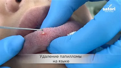 Симптомы рака горла, гортани и языка — как выглядит рак горла, гортани и  языка - 6 декабря 2023 - 63.ру