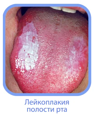 Рак языка: симптомы, диагностика, лечение, стадии и профилактика онкологии